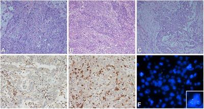 The Use of Immunohistochemistry, Fluorescence in situ Hybridization, and Emerging Epigenetic Markers in the Diagnosis of Malignant Pleural Mesothelioma (MPM): A Review